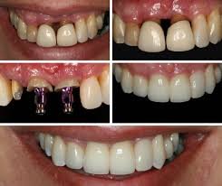 Implante Dentário