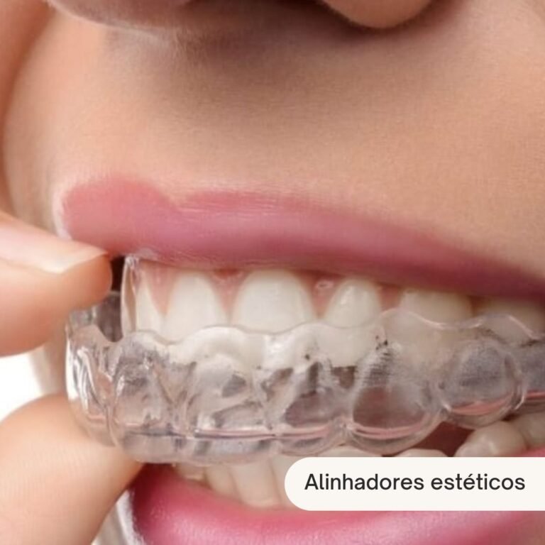 Alinhadores estéticos