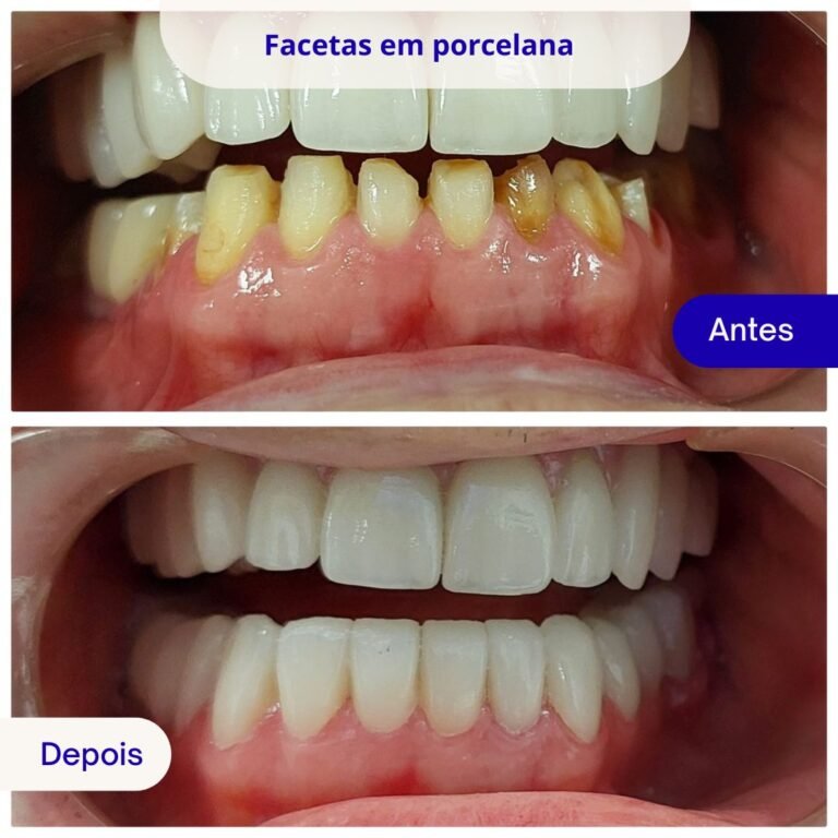 Facetas em porcelana