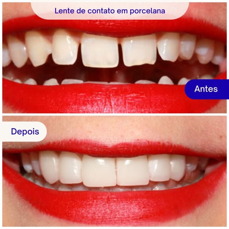 Lente de contato em porcelana