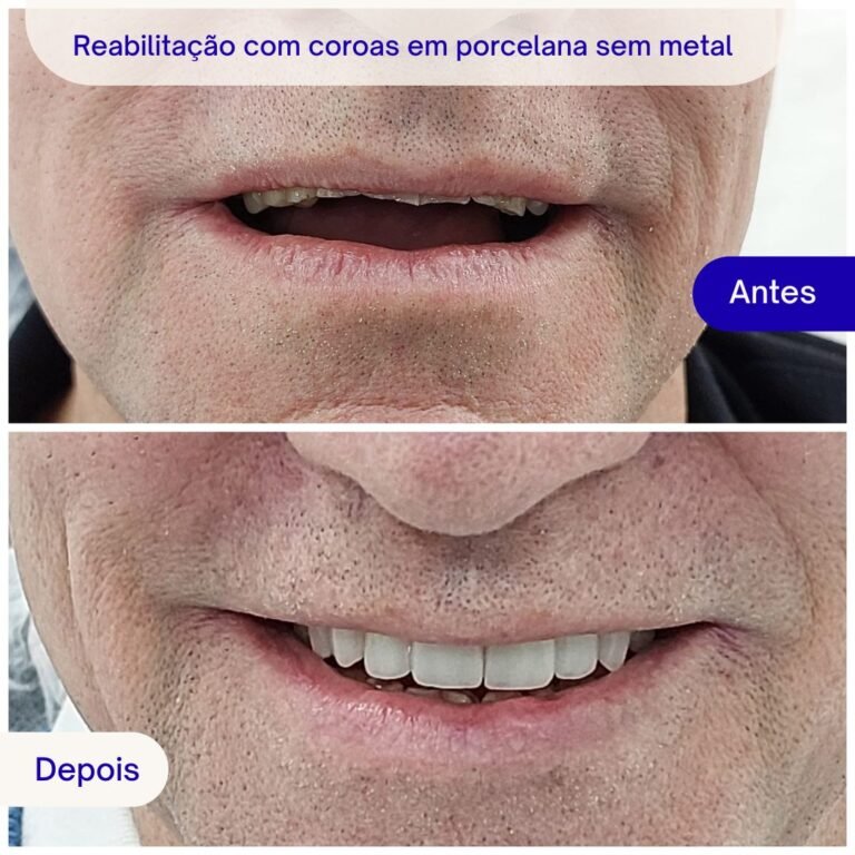 Reabilitação com coroas em porcelana sem metal