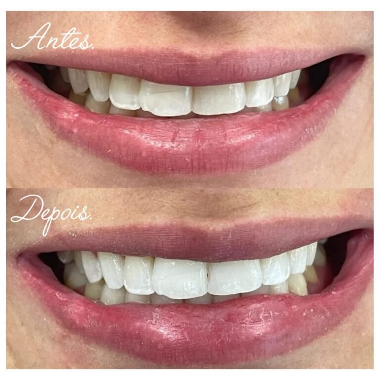 beleza dental clareamento dental (1)