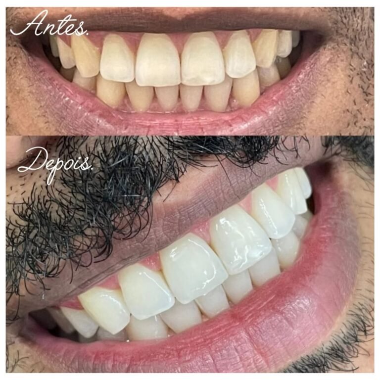 beleza dental clareamento dental (2)
