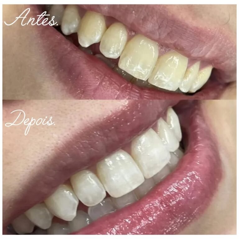 beleza dental clareamento dental (3)