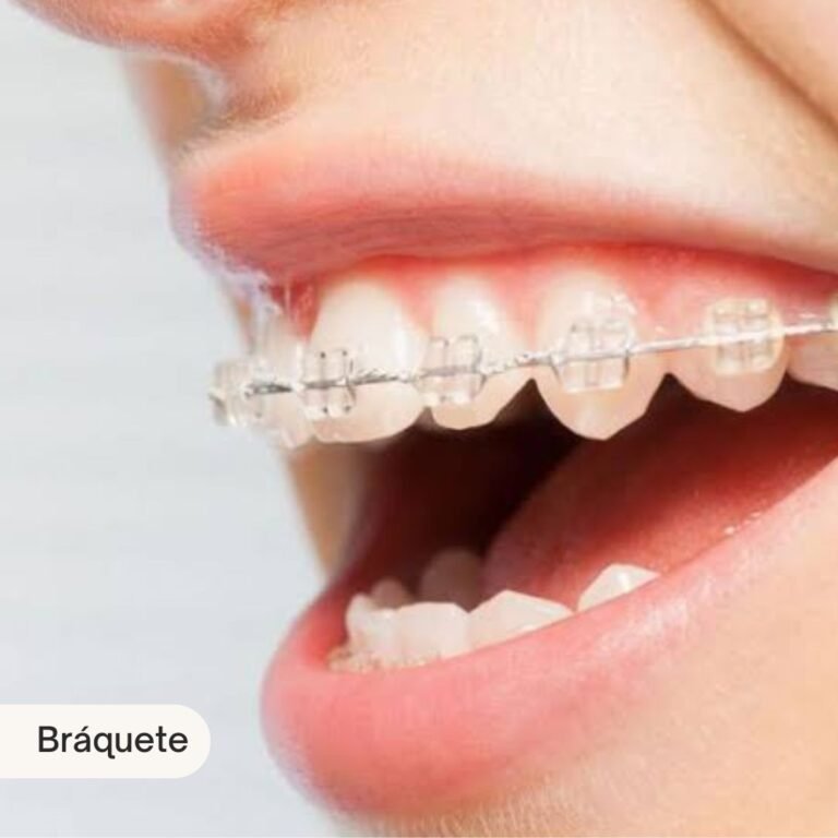 braquete aparelho beleza dental