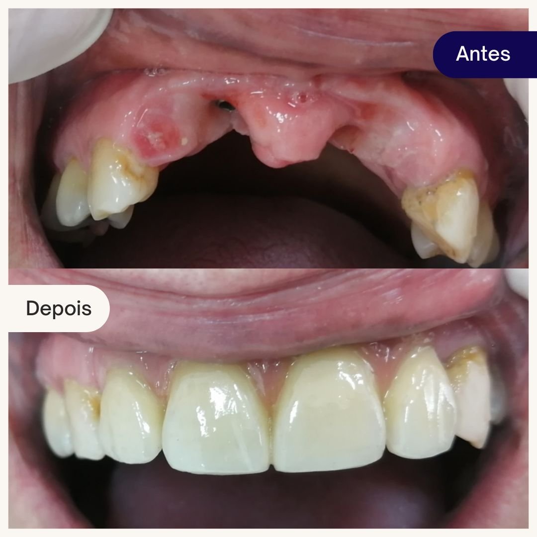 implantes beleza dental (1)