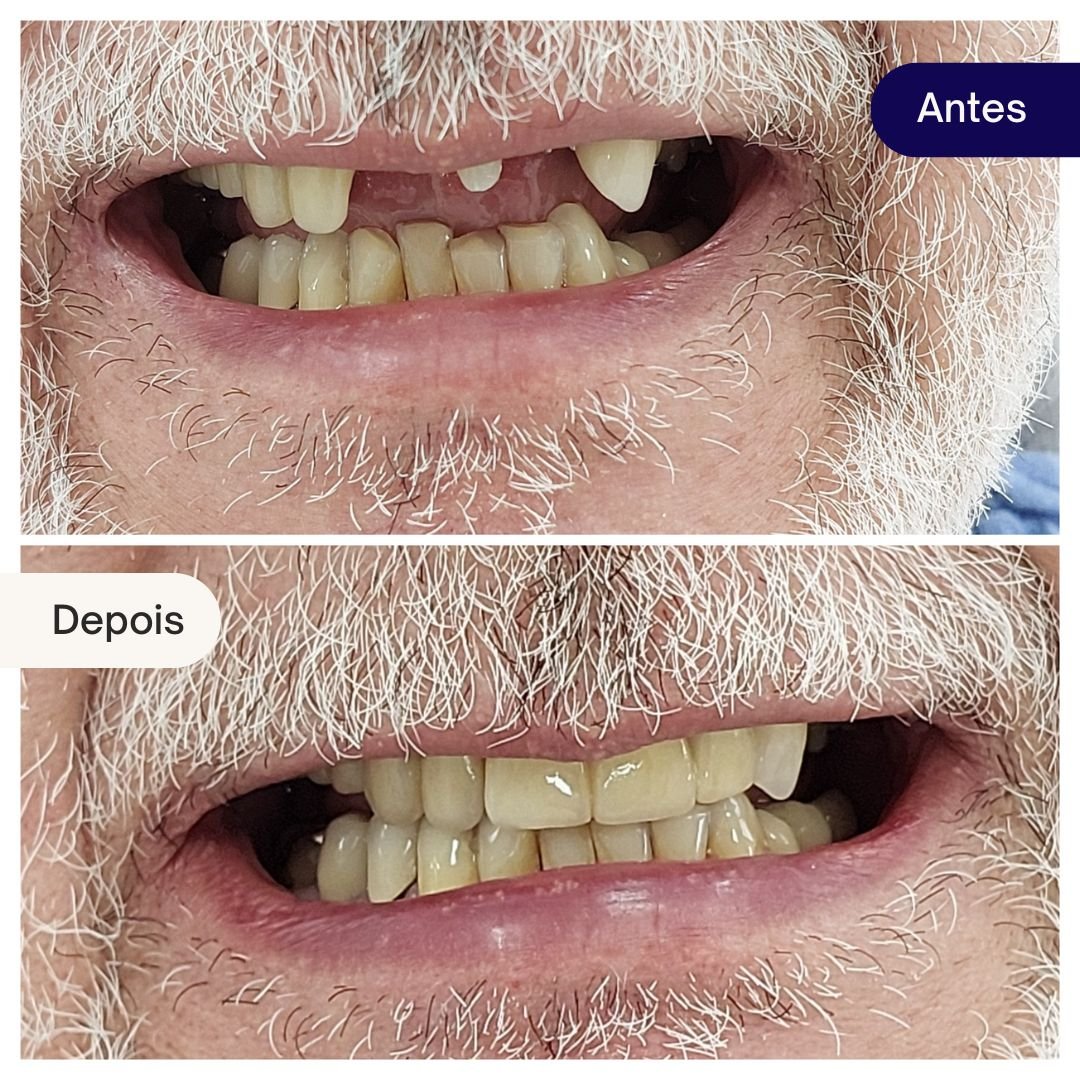 implantes beleza dental (2)