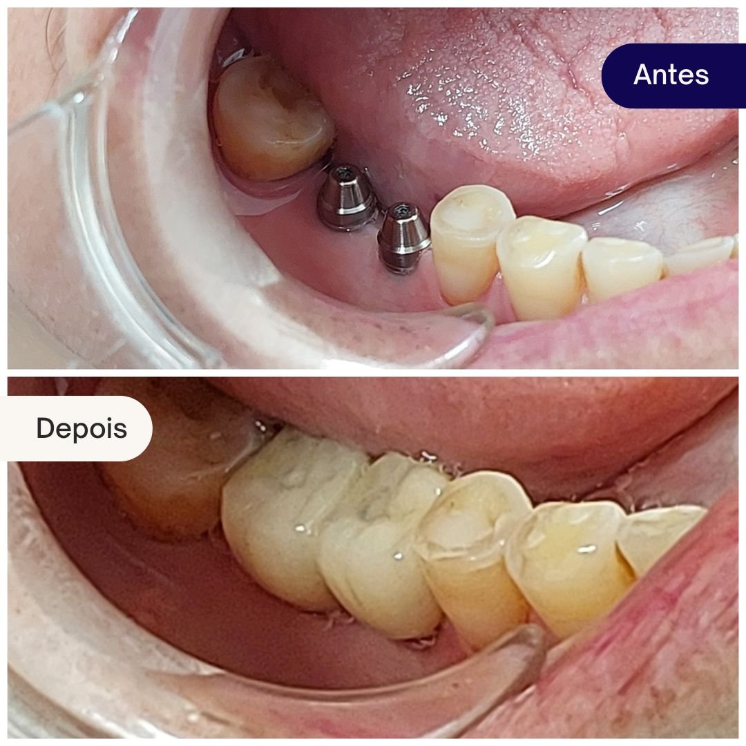 implantes beleza dental (3)