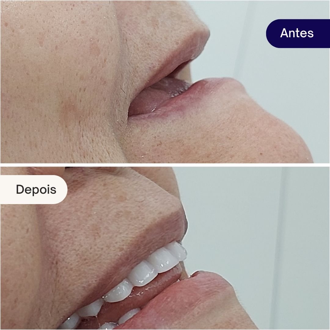 implantes beleza dental (4)