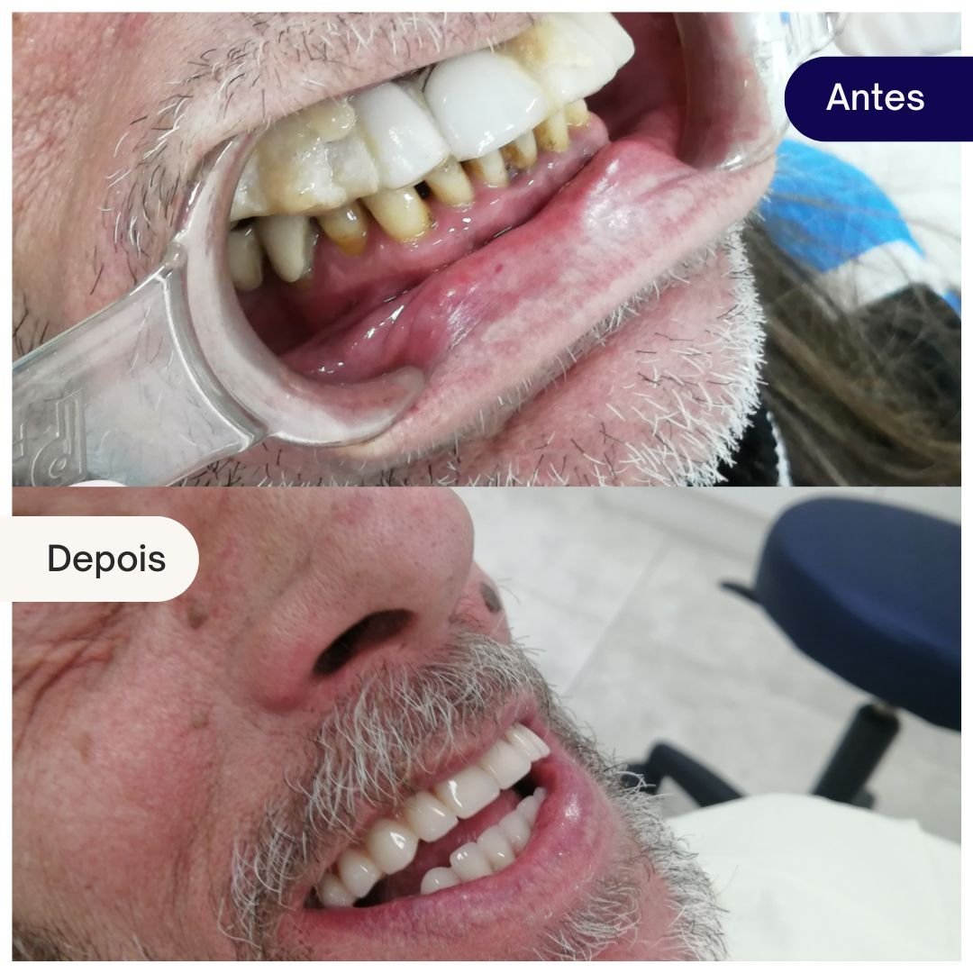implantes beleza dental (5)