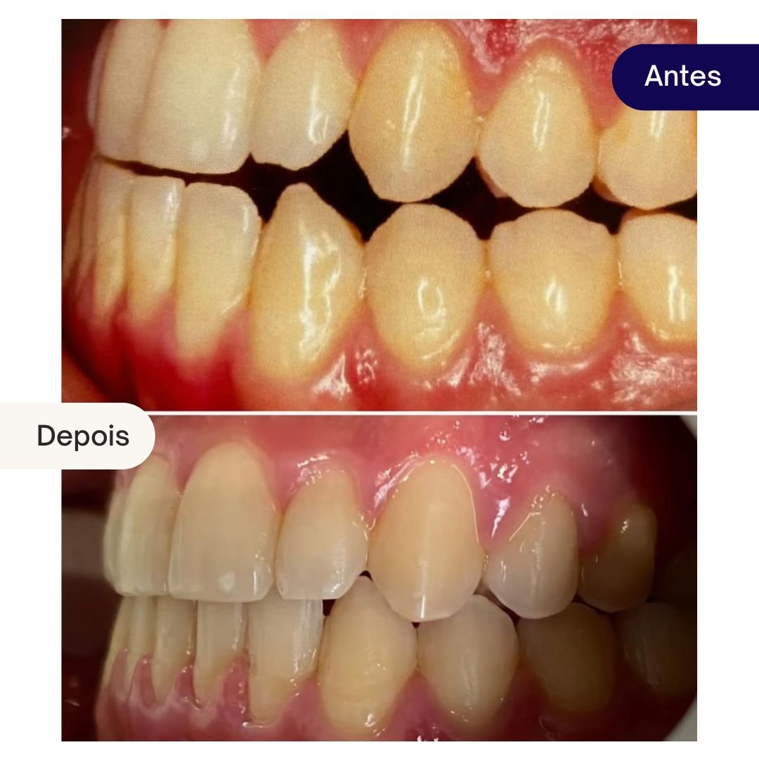 ortodontia beleza dental - caso clinico (1)