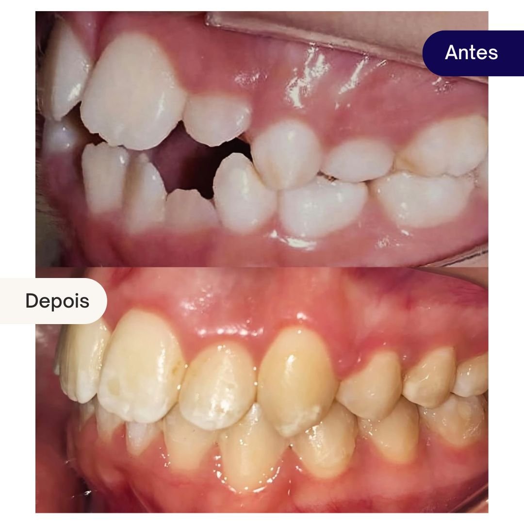 ortodontia beleza dental - caso clinico (2)