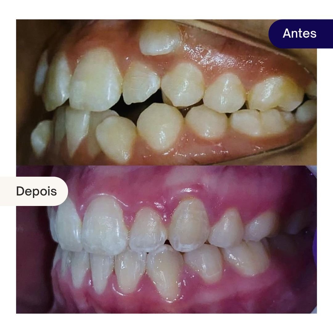 ortodontia beleza dental - caso clinico (3)