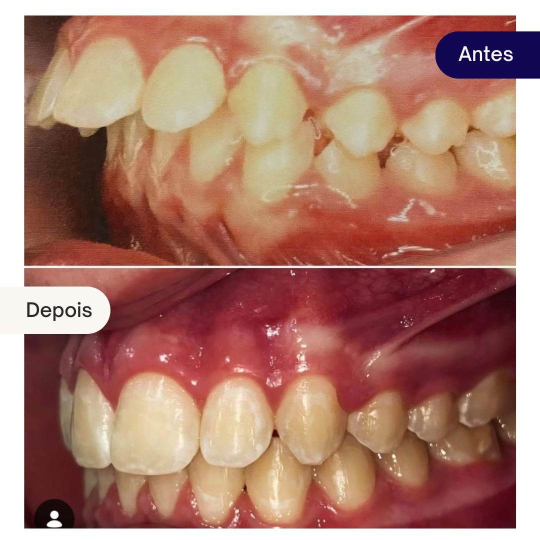 ortodontia beleza dental - caso clinico (4)